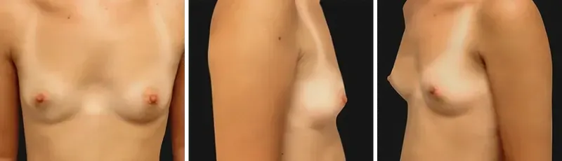 Breast augmentation: before surgery
