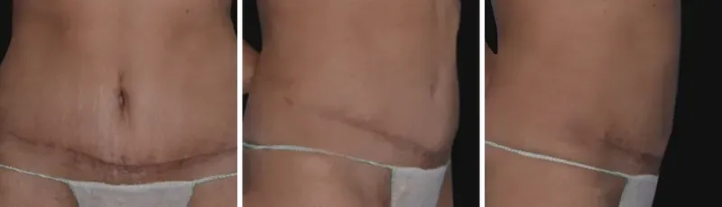 Mini tummy tuck: after surgery