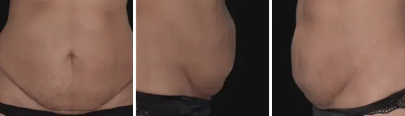 Mini tummy tuck: before surgery